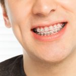 Исправление прикуса и ровные зубы – современные возможности ортодонтии